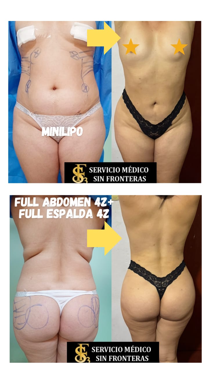 Resultado antes y después 3